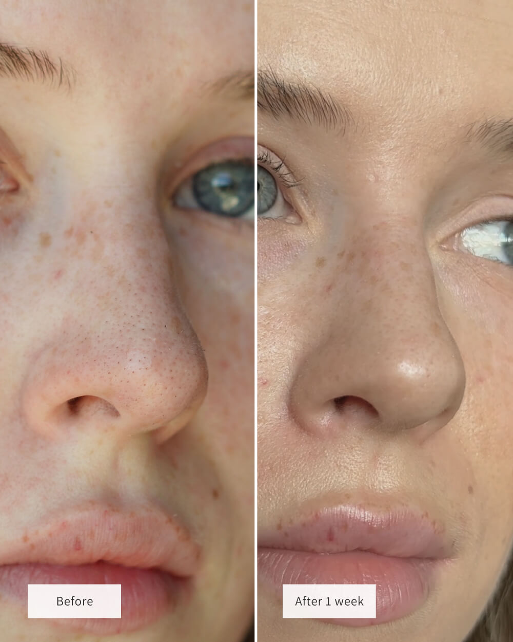 Gloré Nose Patches