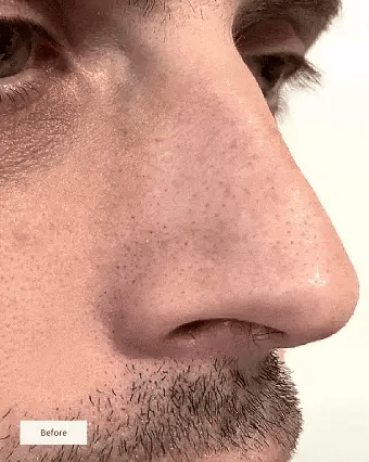 Gloré Nose Patches