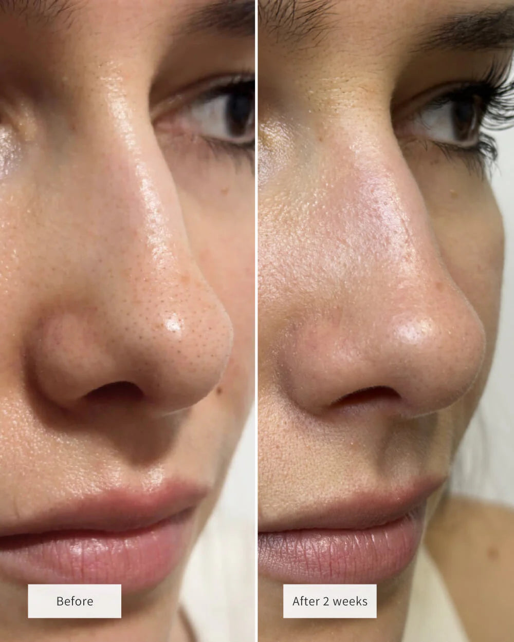 Gloré Nose Patches